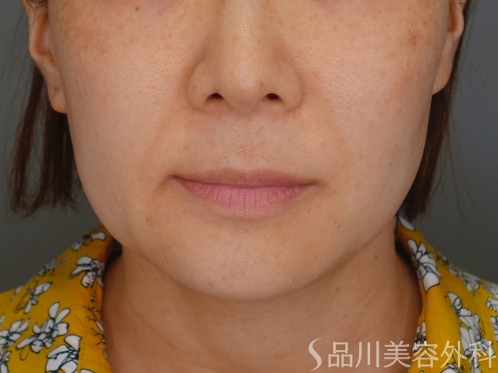 症例NO.69338のBEFORE写真