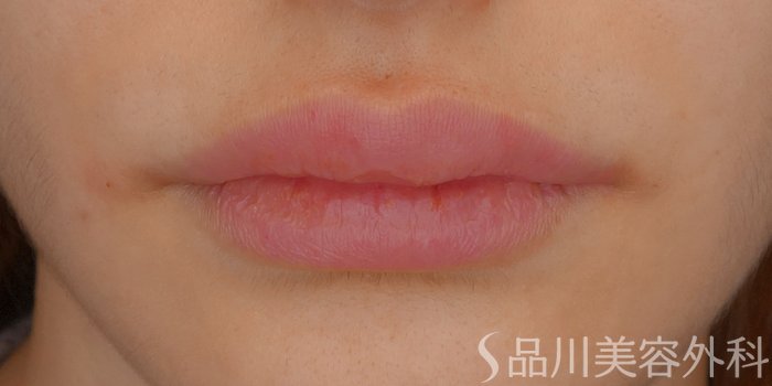 症例NO.72422のAFTER写真