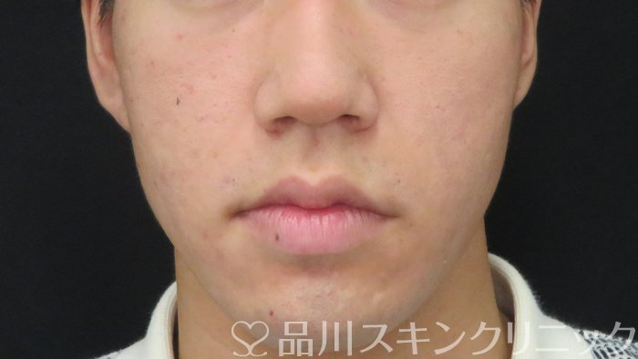 症例NO.71852のBEFORE写真