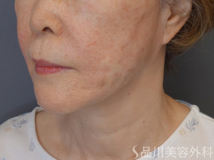 症例NO.71751のAFTER写真