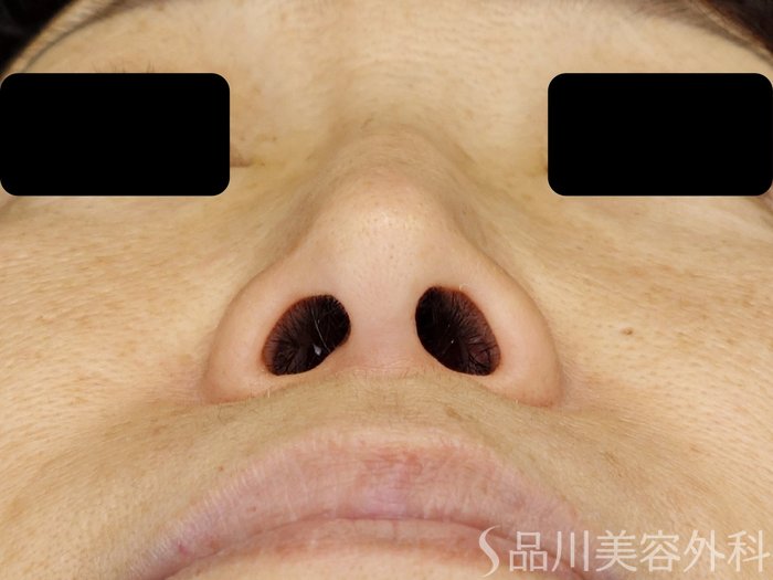 症例NO.71408のBEFORE写真