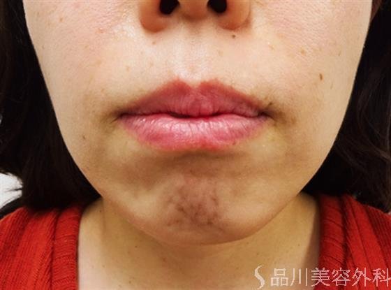 症例NO.32519のBEFORE写真