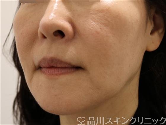 症例NO.37931のAFTER写真