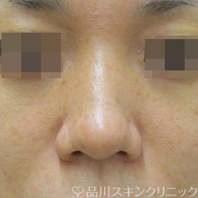 症例NO.71707のBEFORE写真