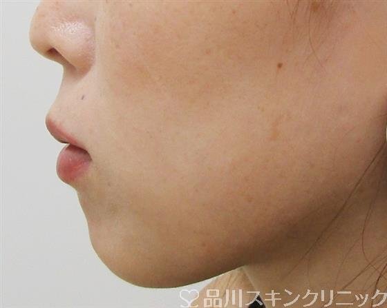 症例NO.37530のBEFORE写真