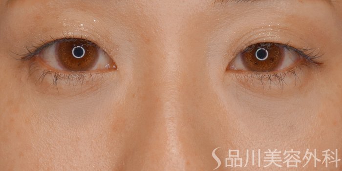 症例NO.70369のAFTER写真