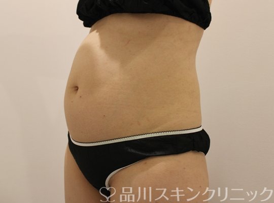 症例NO.64976のBEFORE写真