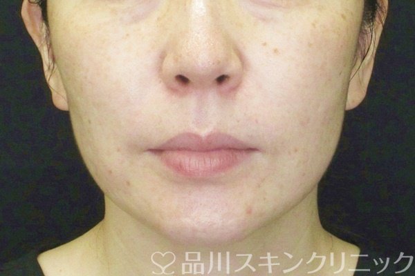 症例NO.65432のAFTER写真