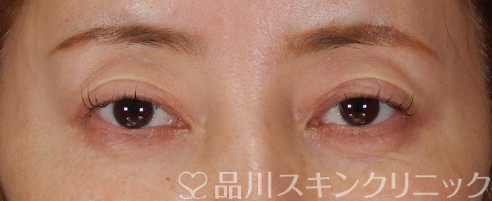 症例NO.65333のBEFORE写真