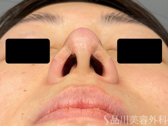 症例NO.65576のAFTER写真