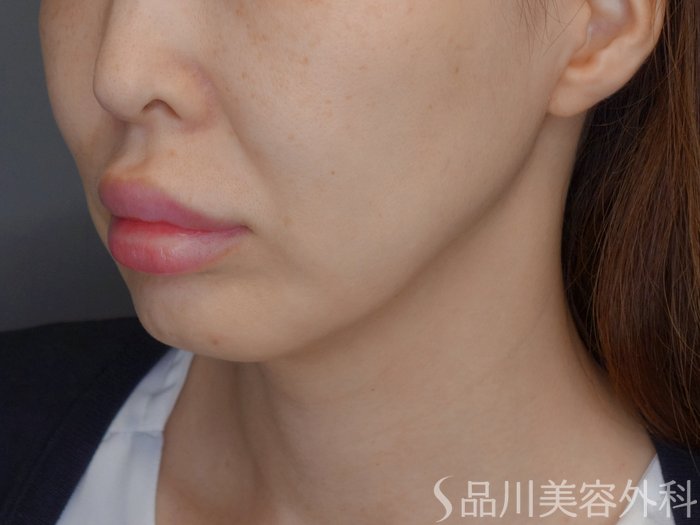 症例NO.71670のBEFORE写真