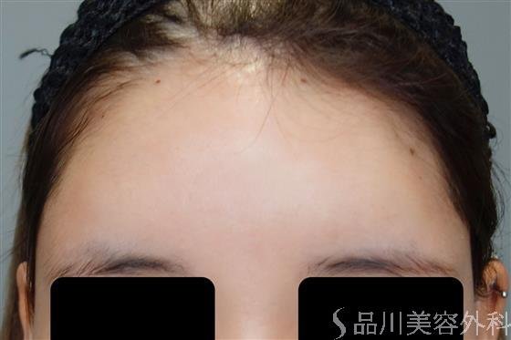 症例NO.50590のAFTER写真