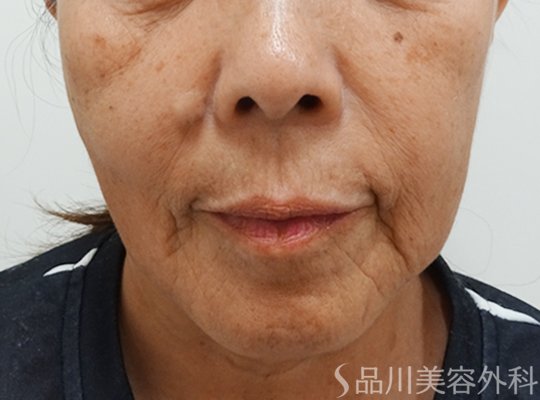 症例NO.73210のBEFORE写真