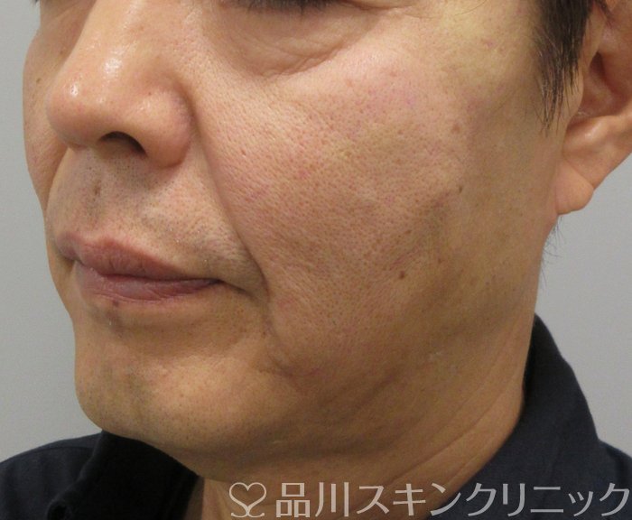 症例NO.74218のAFTER写真