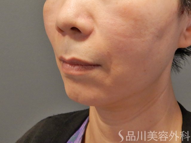 症例NO.74312のAFTER写真