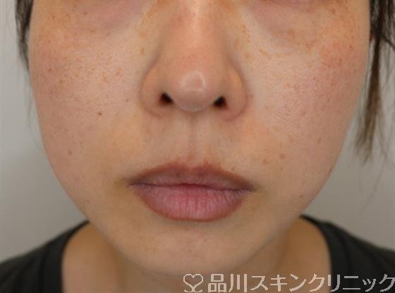 症例NO.47961のAFTER写真