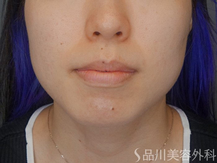 症例NO.71861のAFTER写真