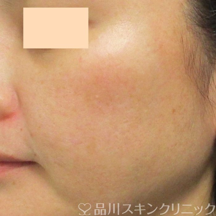 症例NO.69341のBEFORE写真