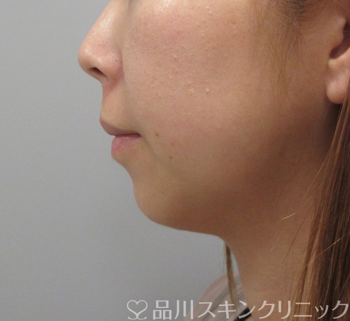 症例NO.74721のBEFORE写真