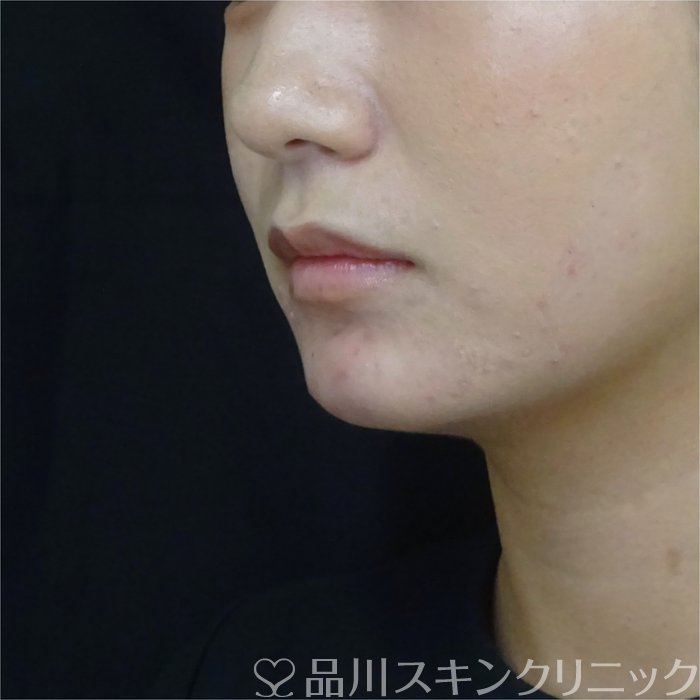 症例NO.71145のAFTER写真