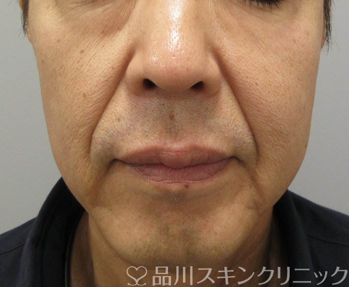 症例NO.74218のBEFORE写真