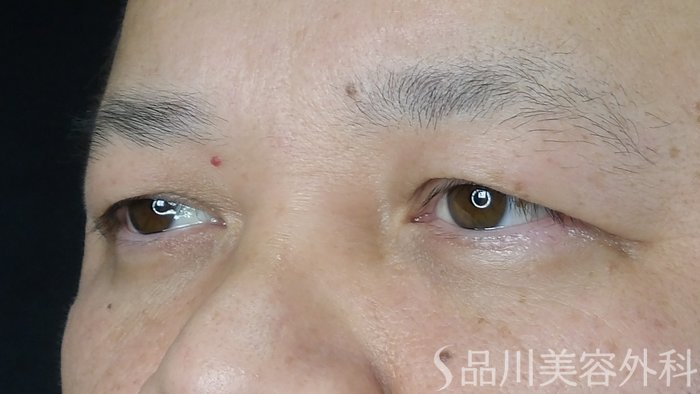 症例NO.70527のBEFORE写真