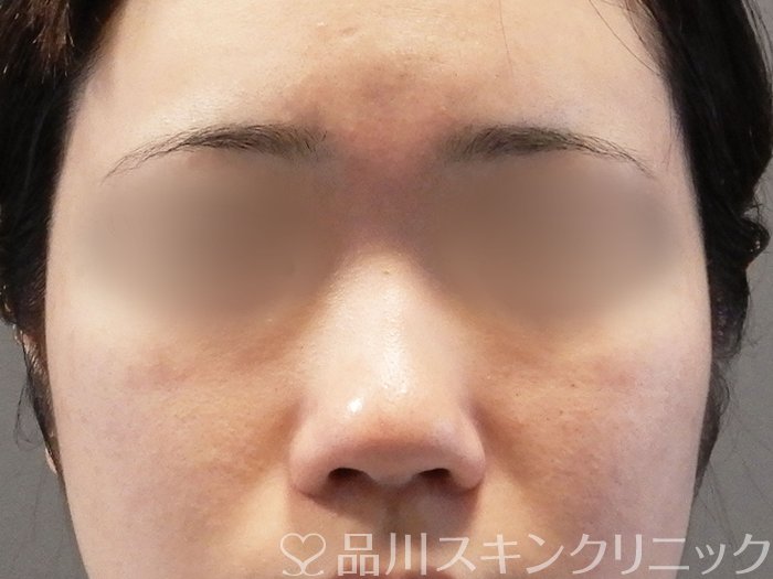 症例NO.65171のBEFORE写真