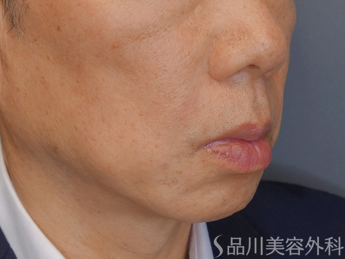 症例NO.73357のAFTER写真
