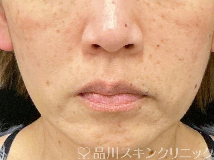 症例NO.73583のBEFORE写真