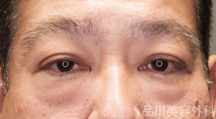 症例NO.69898のBEFORE写真