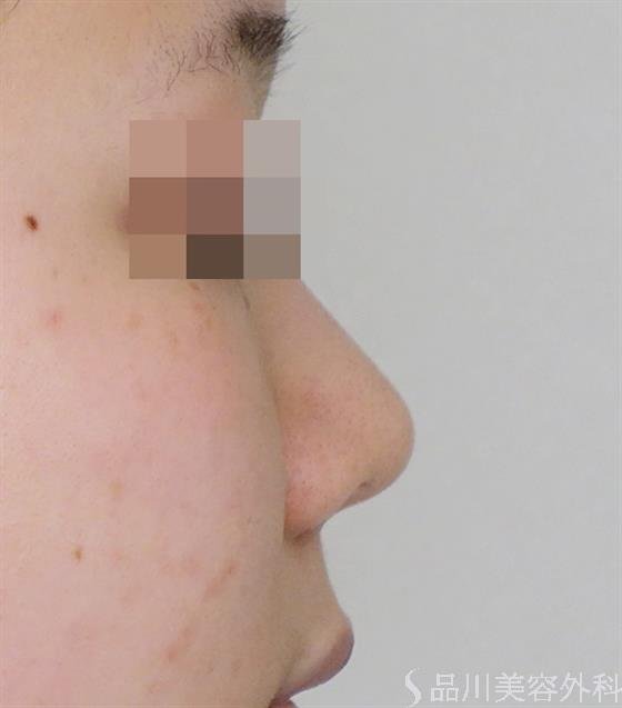 症例NO.50988のBEFORE写真
