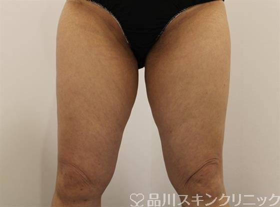 症例NO.45311のAFTER写真