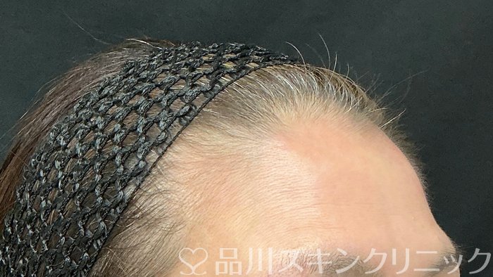 症例NO.74874のBEFORE写真
