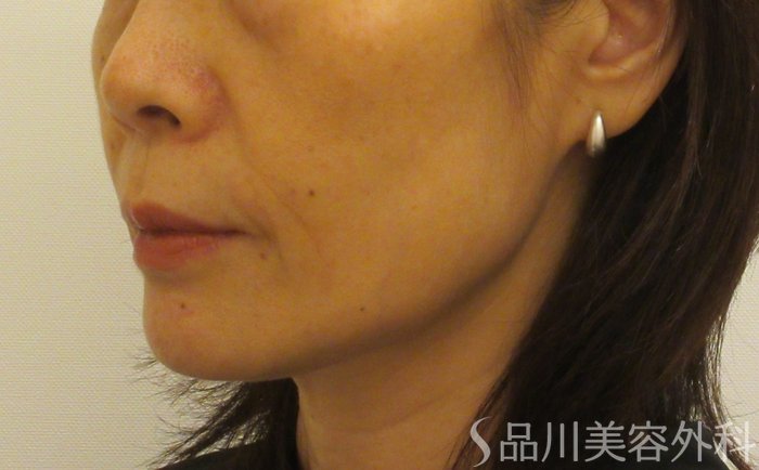 症例NO.71739のBEFORE写真