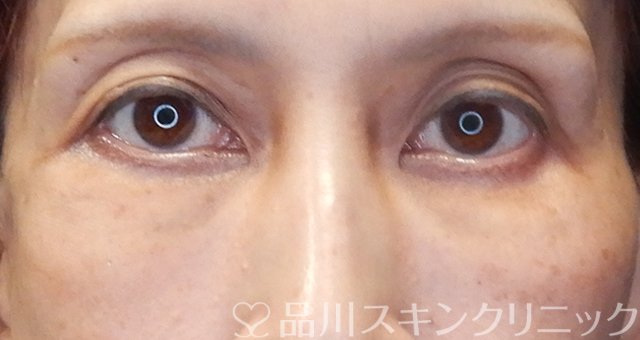 症例NO.67975のAFTER写真