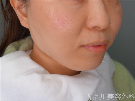 症例NO.55049のAFTER写真