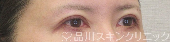 症例NO.71138のAFTER写真