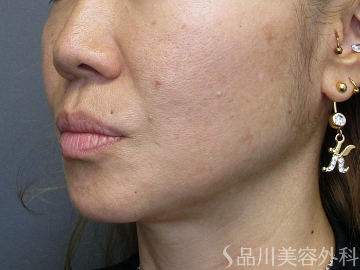 症例NO.75204のBEFORE写真
