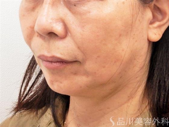 症例NO.52607のAFTER写真