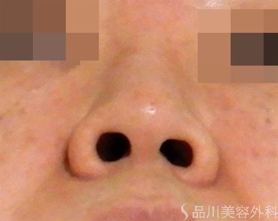 症例NO.42215のBEFORE写真
