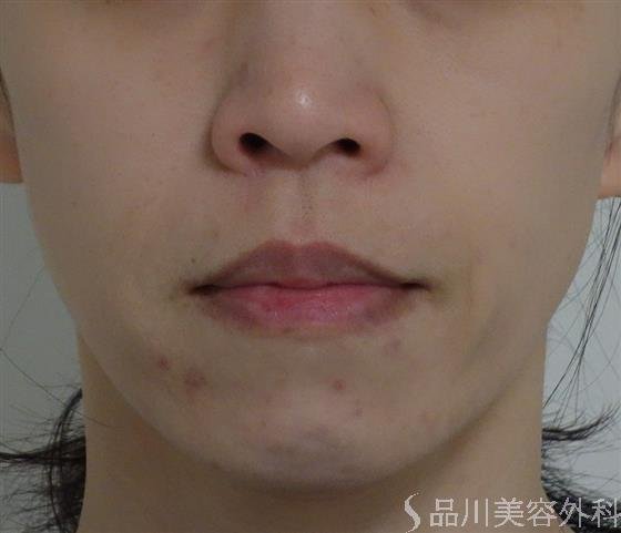 症例NO.50060のAFTER写真