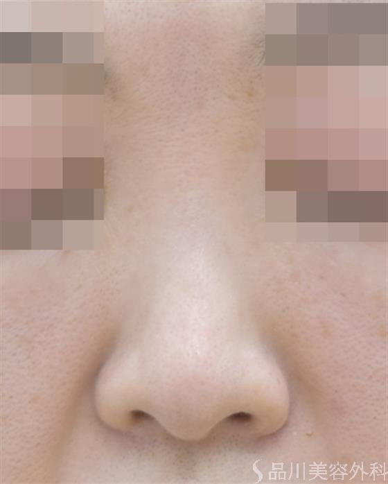 症例NO.46181のBEFORE写真