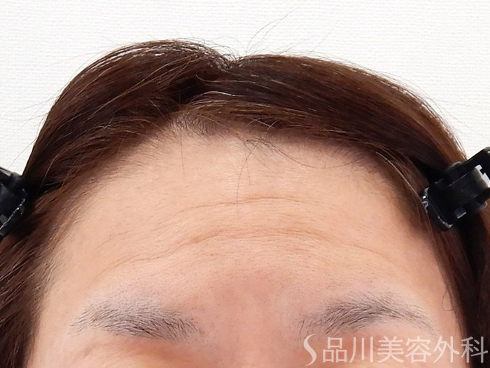 症例NO.62192のBEFORE写真