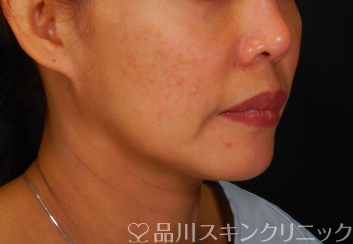 症例NO.66823のBEFORE写真