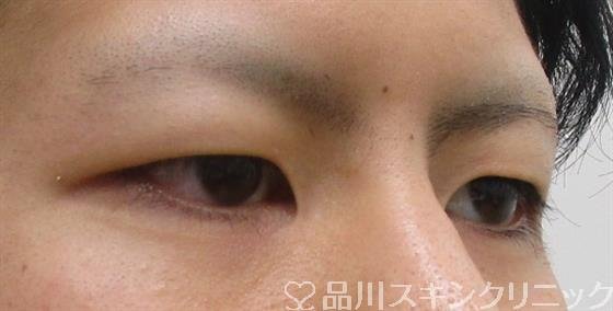 症例NO.42339のBEFORE写真