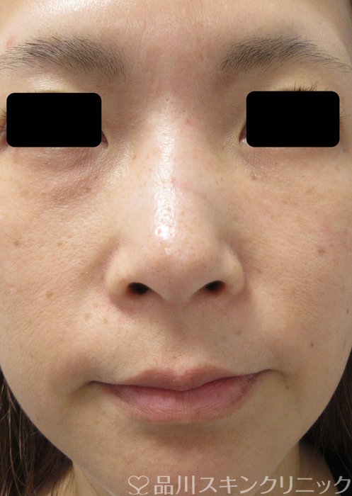 症例NO.73518のBEFORE写真