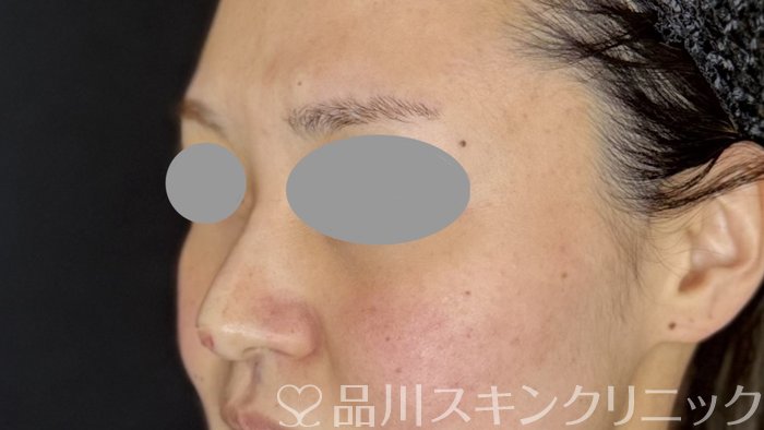 症例NO.67970のAFTER写真