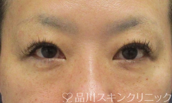 症例NO.69624のBEFORE写真