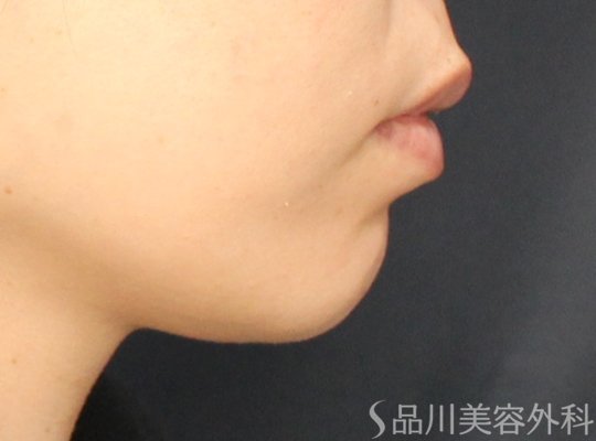 症例NO.73686のBEFORE写真