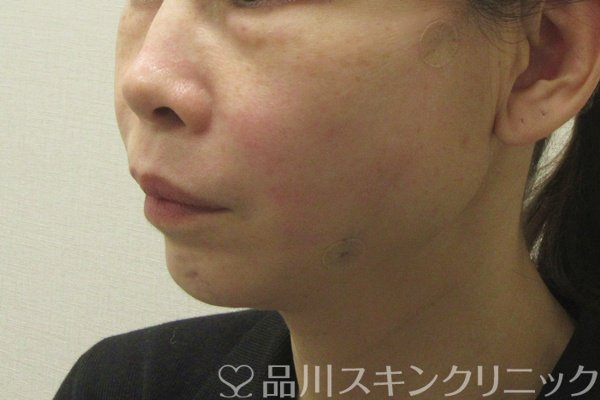症例NO.74830のAFTER写真